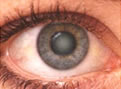 cataract eye