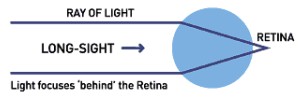 long sightedness eye